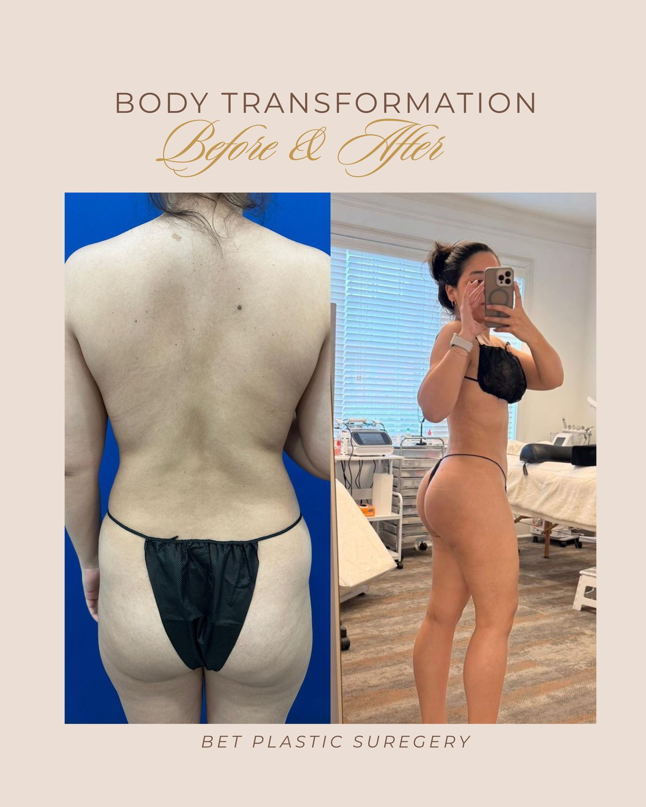 Resultado real de paciente de Dr. Bart Kachniarz en BET Aesthetics Center