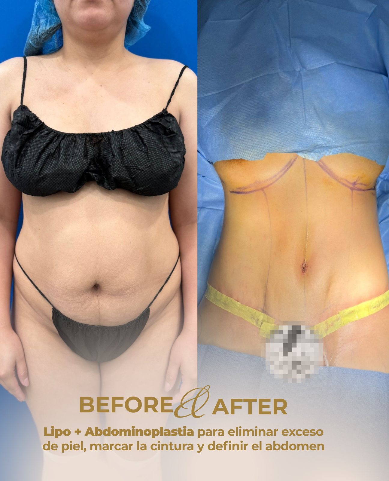 Resultado real de paciente de Dr. Bart Kachniarz en BET Aesthetics Center