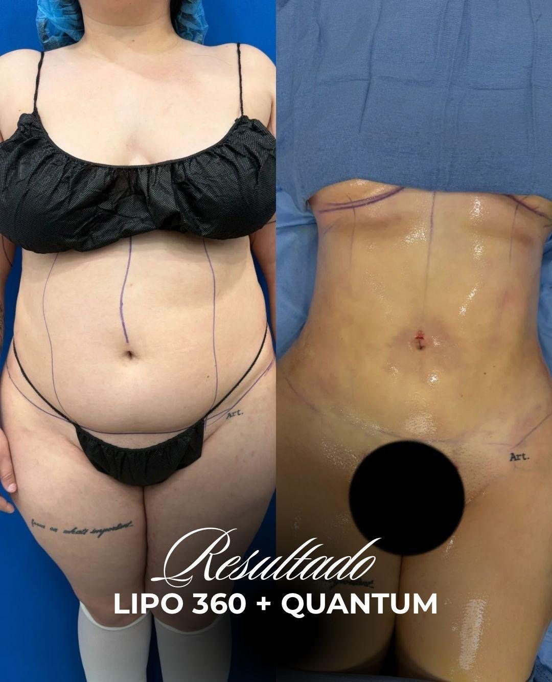 Resultado real de paciente de Dr. Bart Kachniarz en BET Aesthetics Center