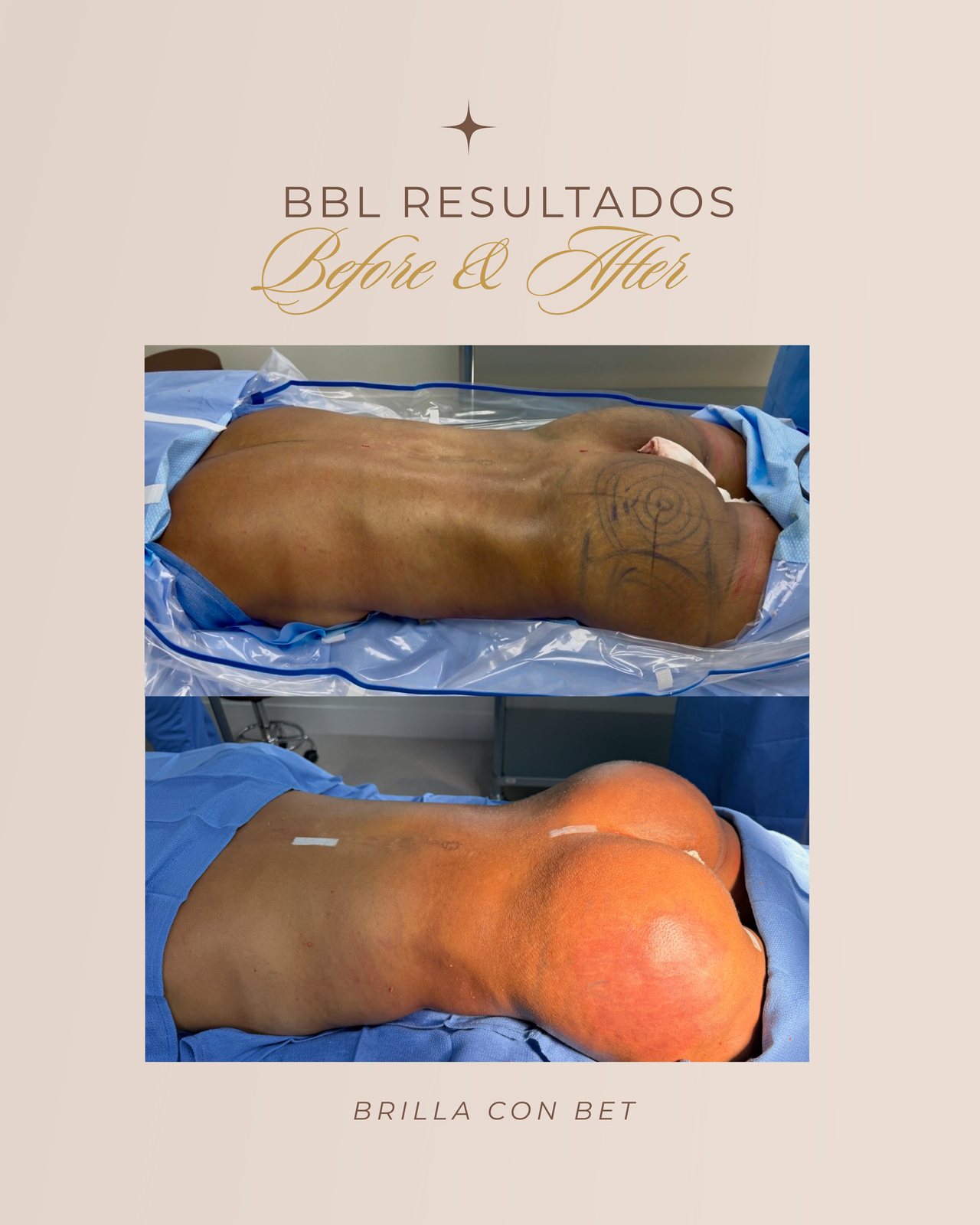 Resultado real de paciente de Dr. Felippe Sartorato en BET Aesthetics Center