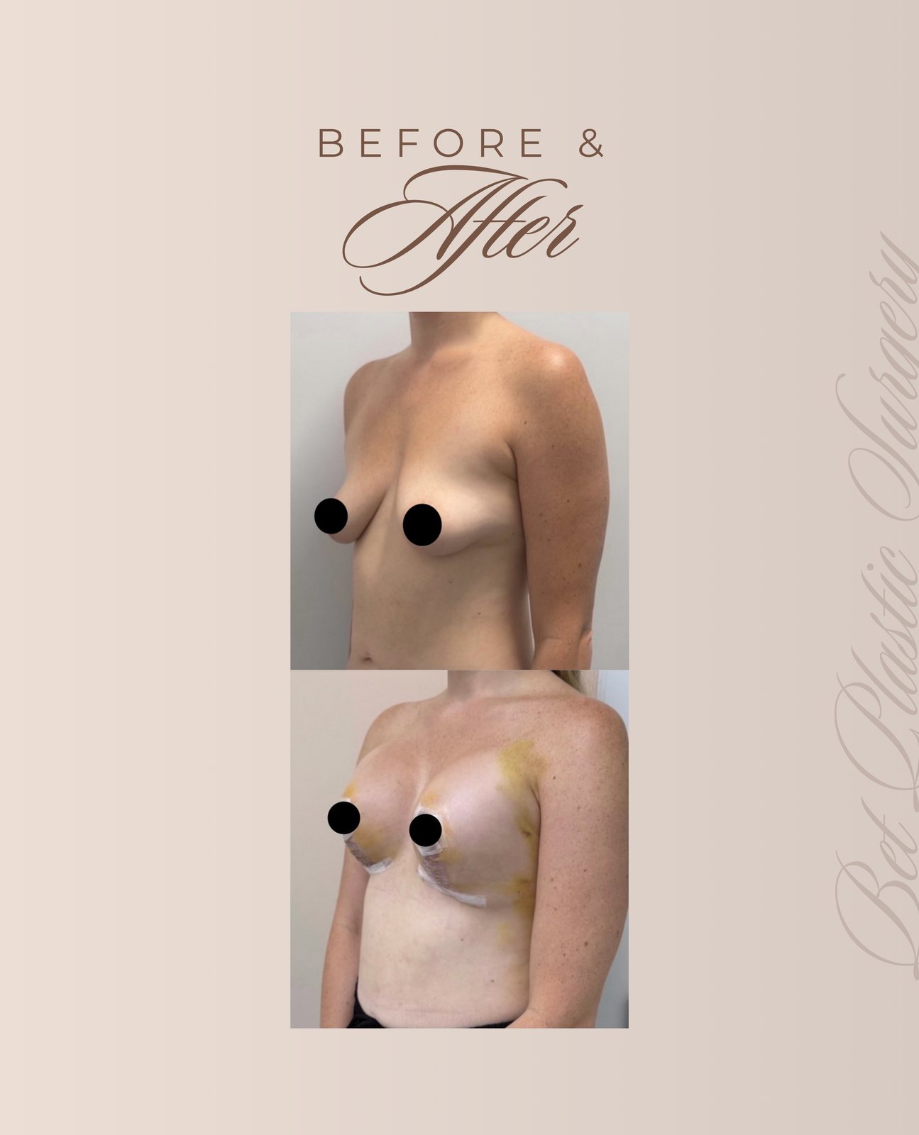 Resultado real de paciente de Dr. Felippe Sartorato en BET Aesthetics Center
