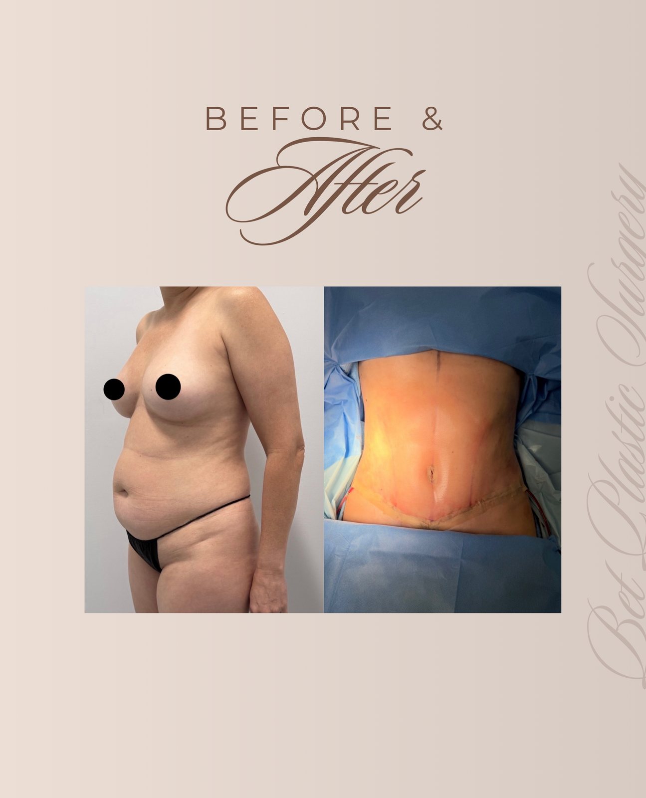 Resultado real de paciente de Dr. Felippe Sartorato en BET Aesthetics Center