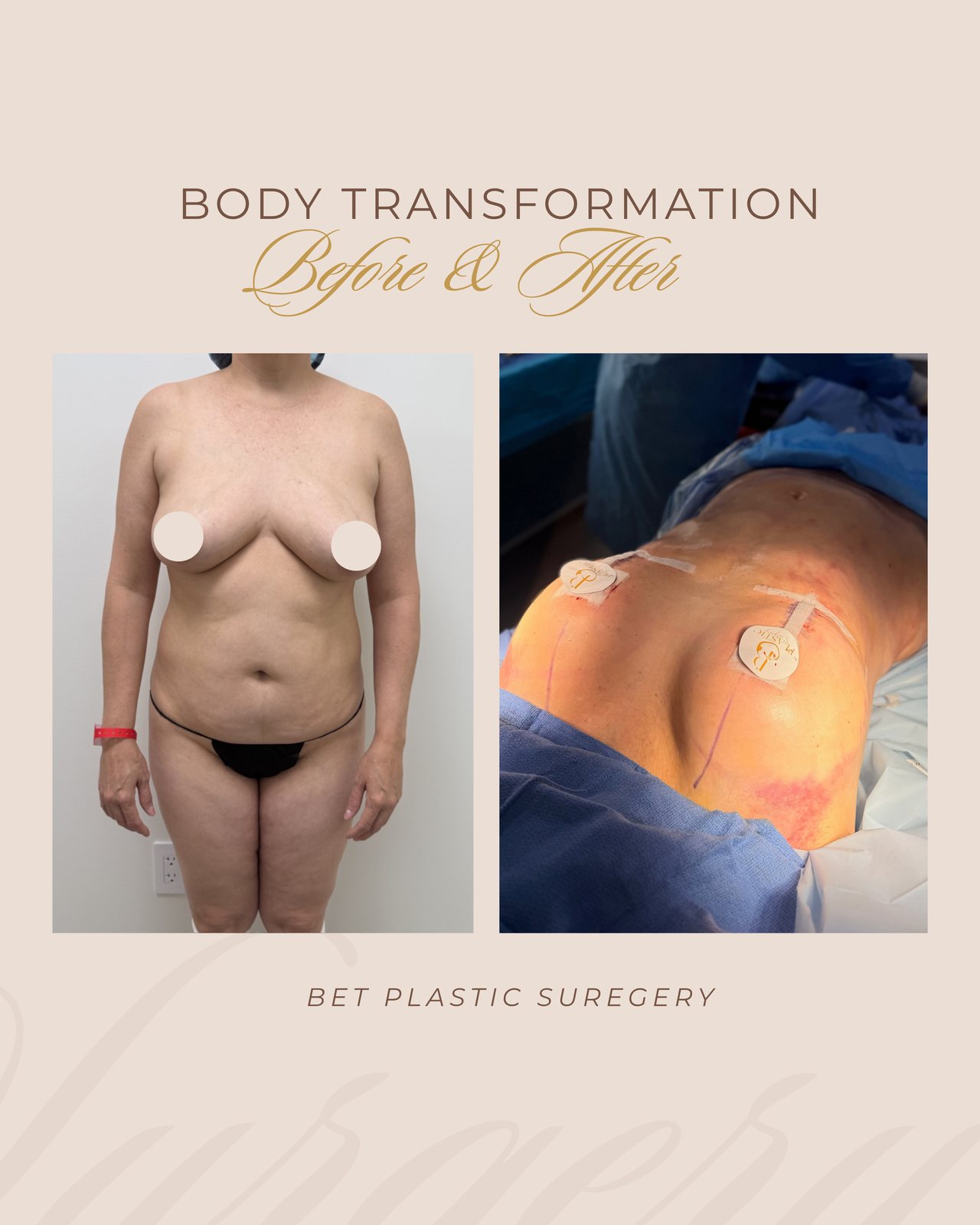 Resultado real de paciente de Dr. Felippe Sartorato en BET Aesthetics Center