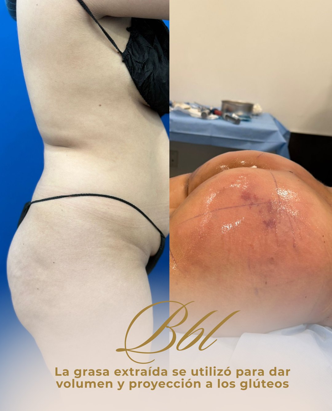Paciente real de BBL — Brazilian Butt Lift en BET Aesthetics Center