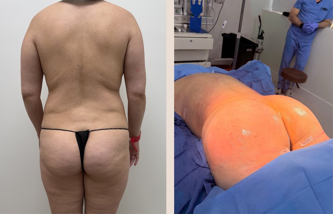 Paciente real de BBL — Brazilian Butt Lift en BET Aesthetics Center