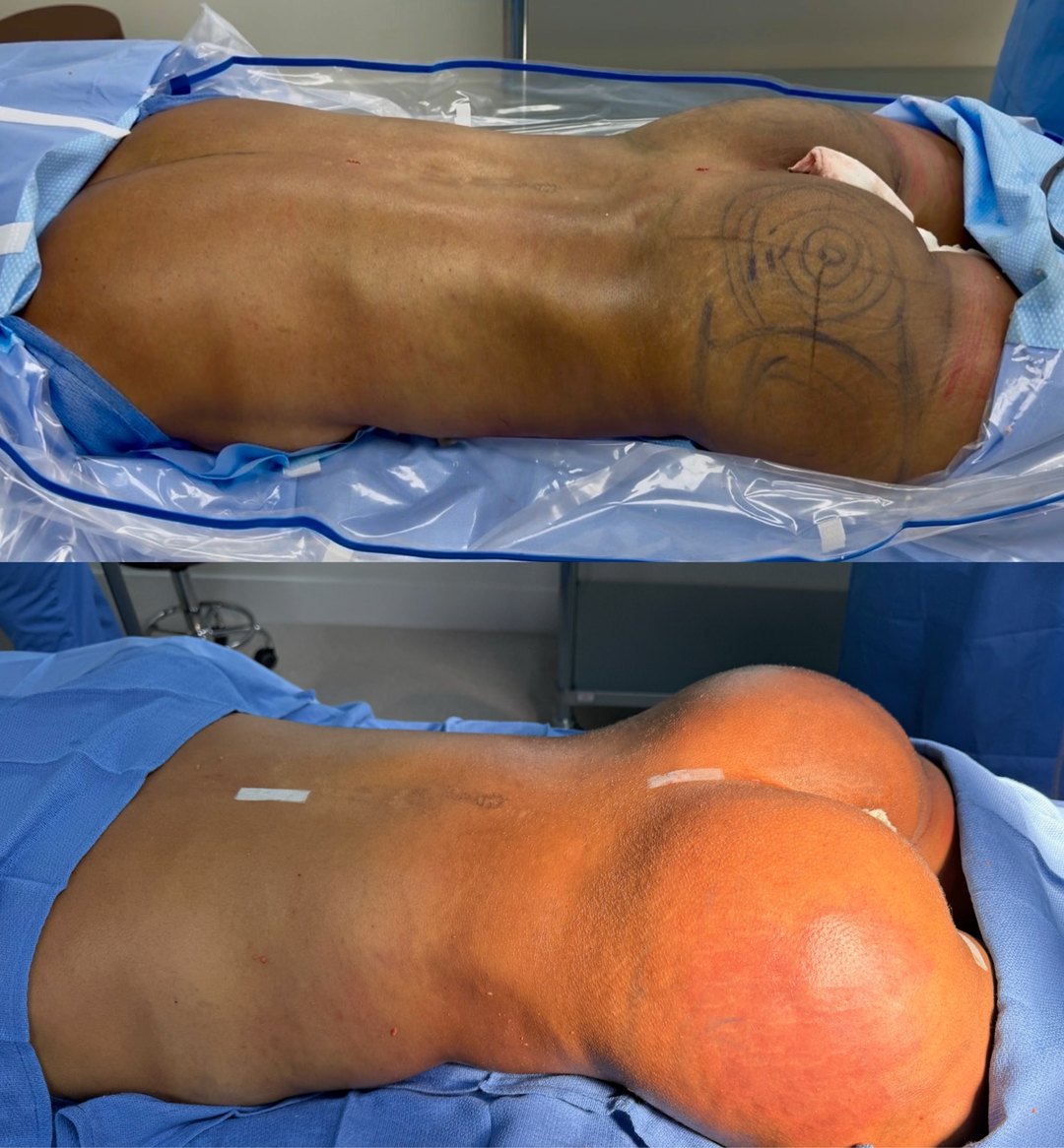 Paciente real de BBL — Brazilian Butt Lift en BET Aesthetics Center