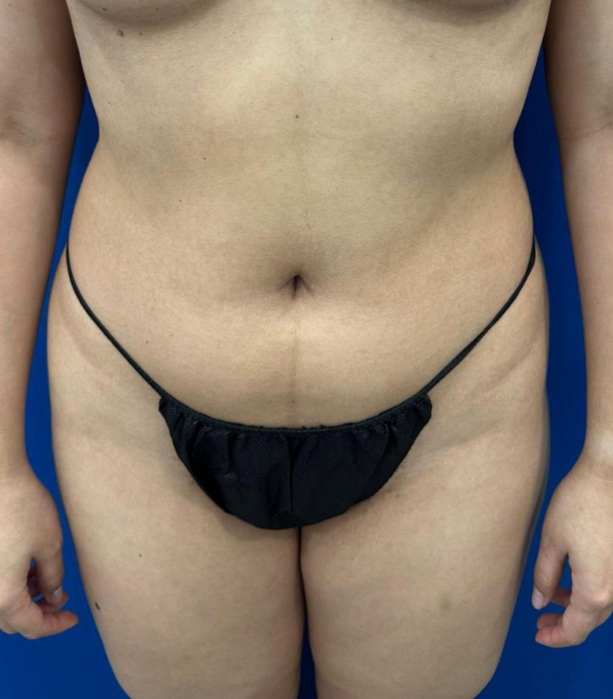 Antes de Lipo 360° — paciente real de BET Aesthetics Center