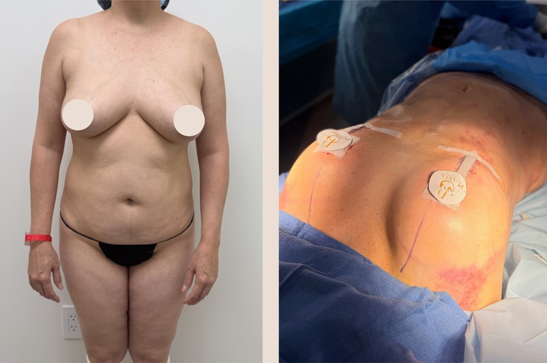 Paciente real de Lipo 360° en BET Aesthetics Center