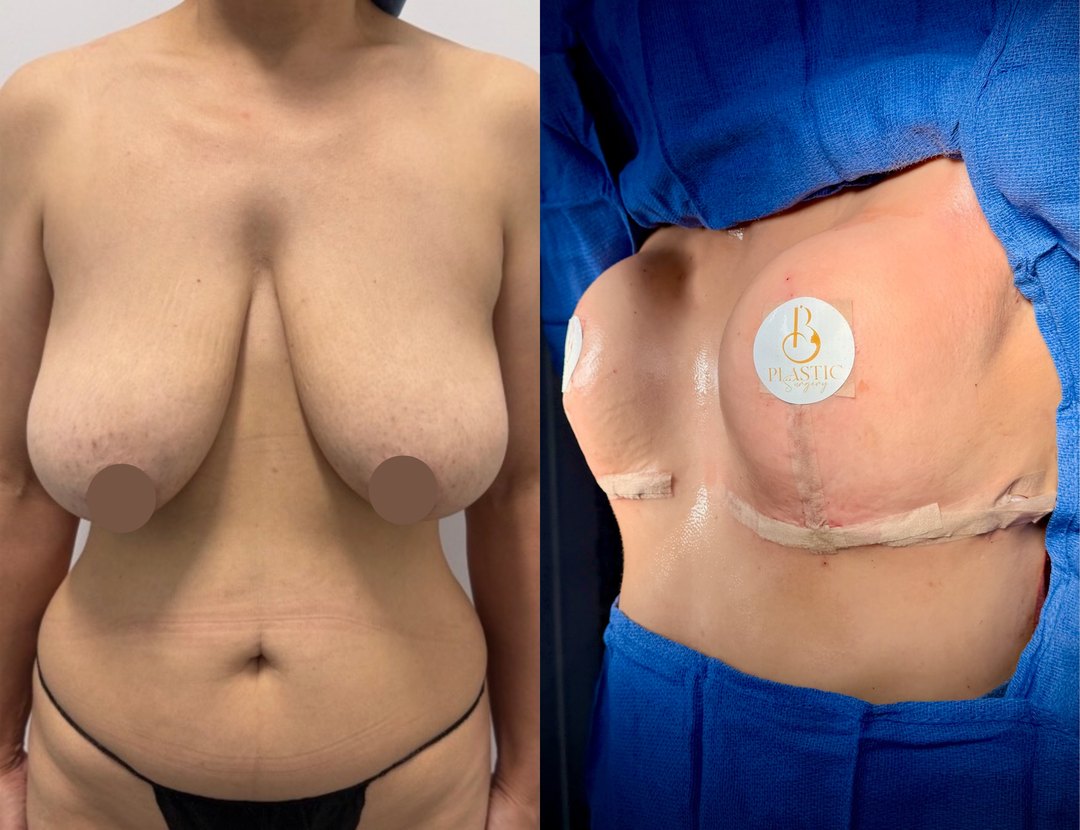 Paciente real de Mommy Makeover en BET Aesthetics Center
