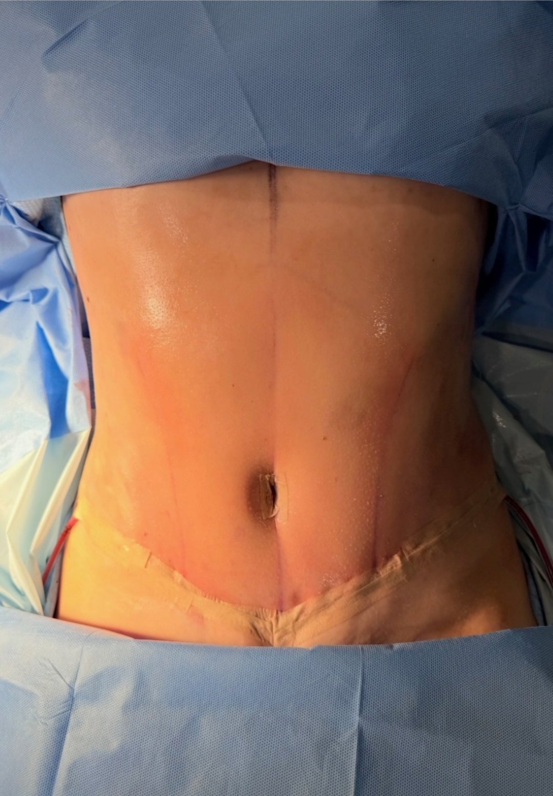 Paciente real de Tummy Tuck en BET Aesthetics Center