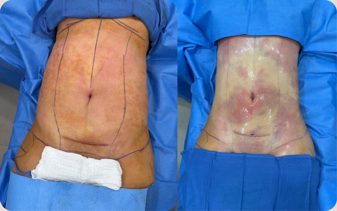 Paciente real de Tummy Tuck en BET Aesthetics Center