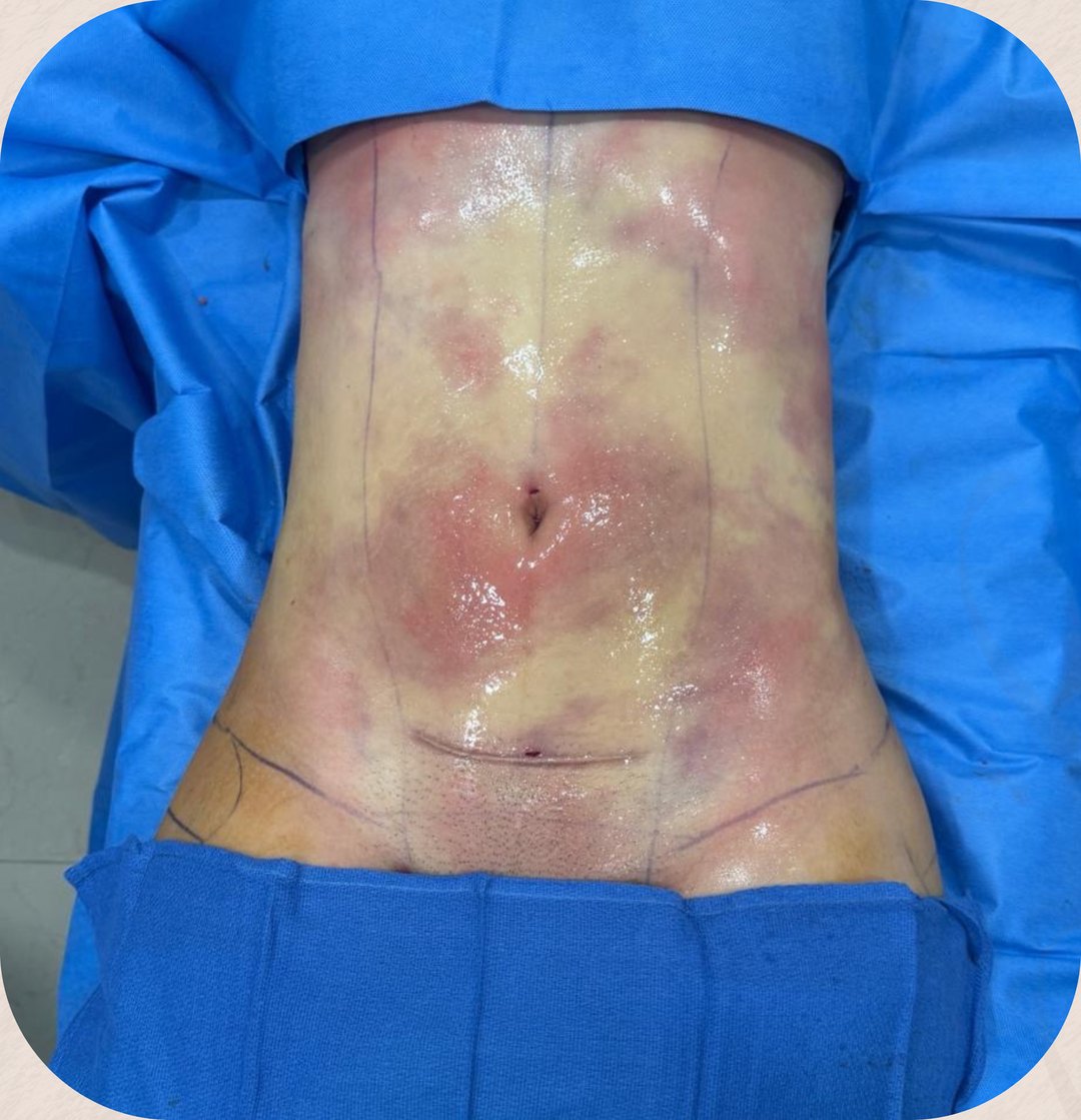 Paciente real de Tummy Tuck en BET Aesthetics Center