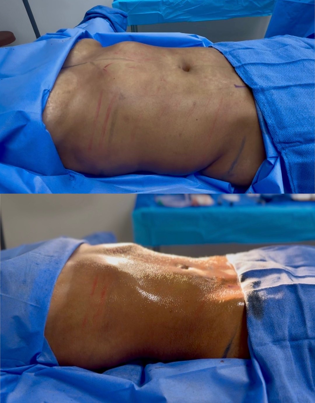Paciente real de Tummy Tuck en BET Aesthetics Center